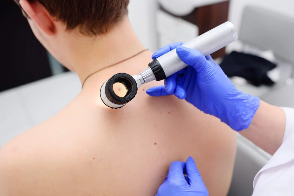 Diagnosticarea melanomului Diagnosticarea melanomului