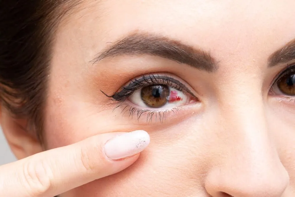 Vase de sange sparte la ochi: ce trebuie sa stii despre hemoragia subconjunctivala