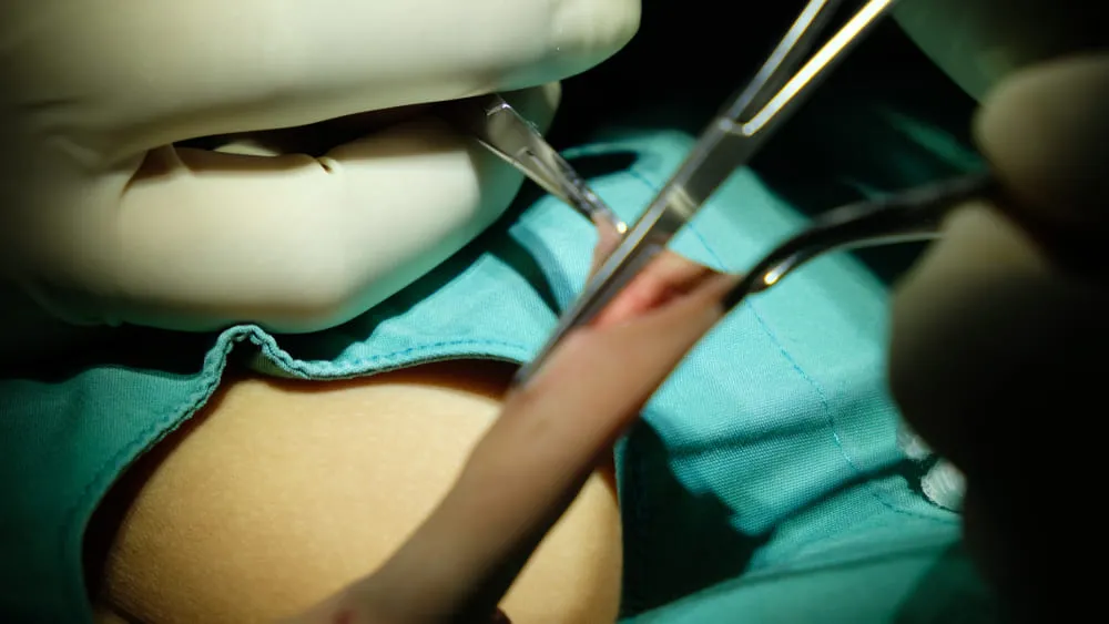 Procedura de circumcizie