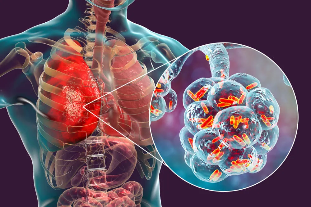 Simptomele infectiilor cauzate de Klebsiella