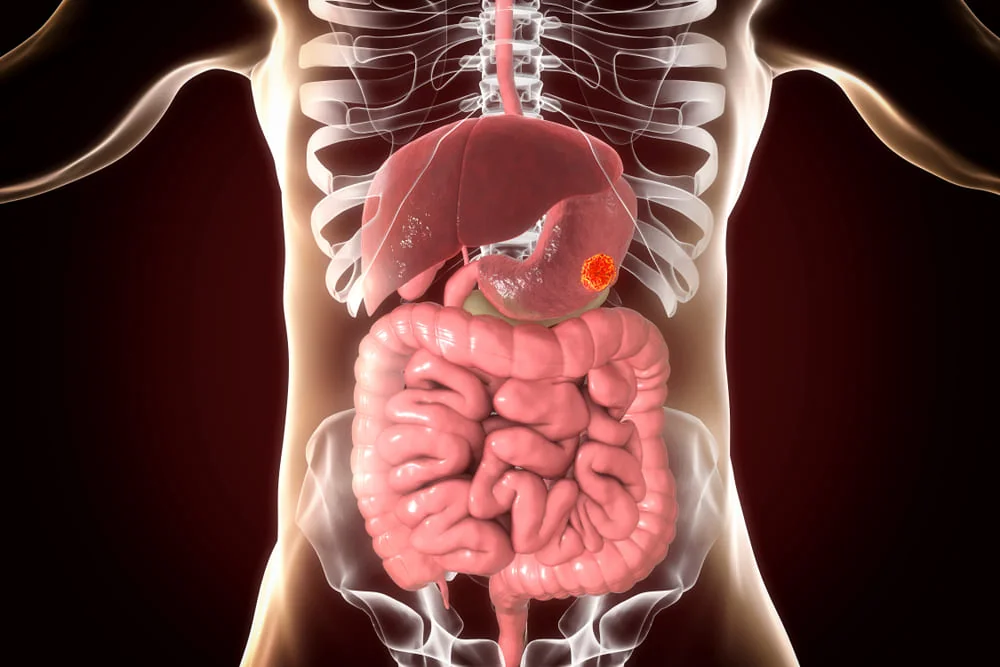cancerul gastric ce este cancerul gastric ce este