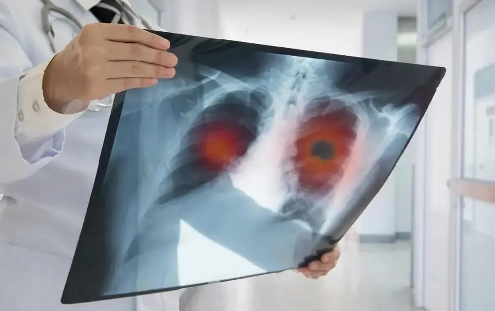 Radiografie pulmonara