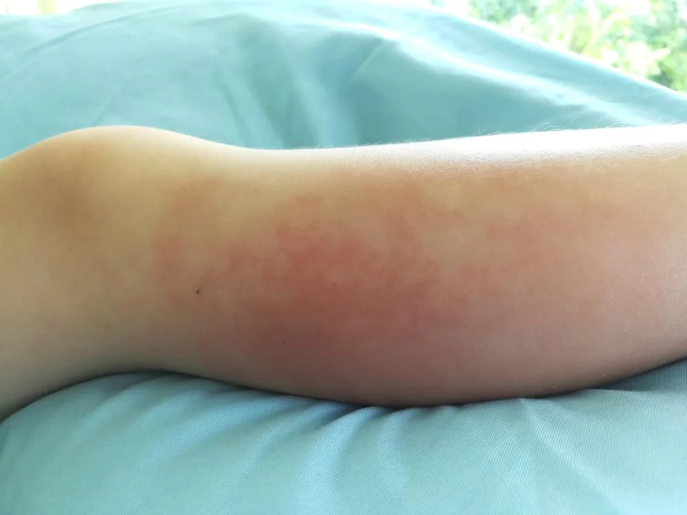 Celulita infectioasa: cauze, simptome, tratament