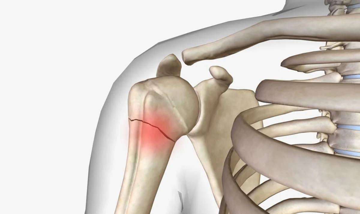 Fractura de humerus: cauze, simptome, tratament
