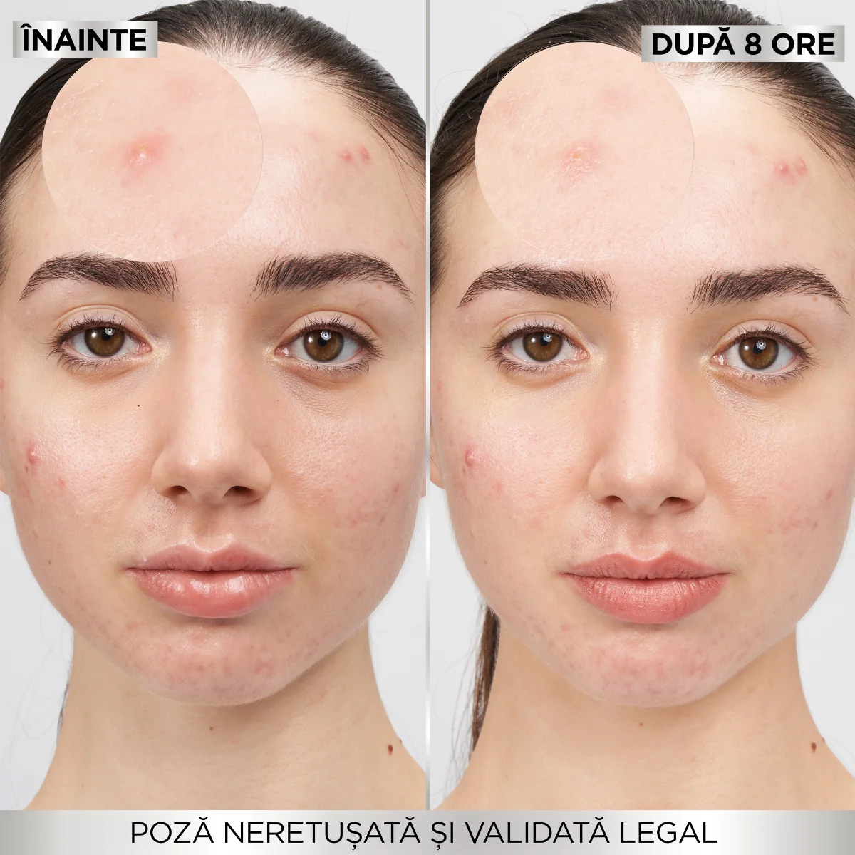 Plasturi invizibili pentru cosuri Pure Active, 22 bucati, Garnier