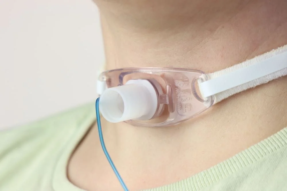 Traheostomie: ce este si cand se recomanda