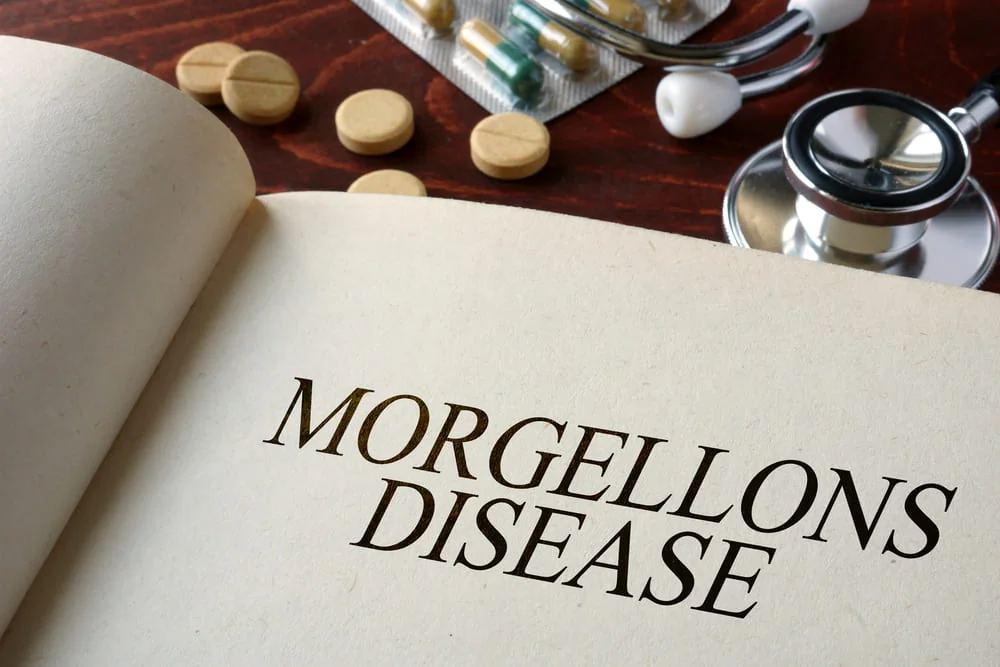 Boala Morgellons: cauze, simptome, tratament