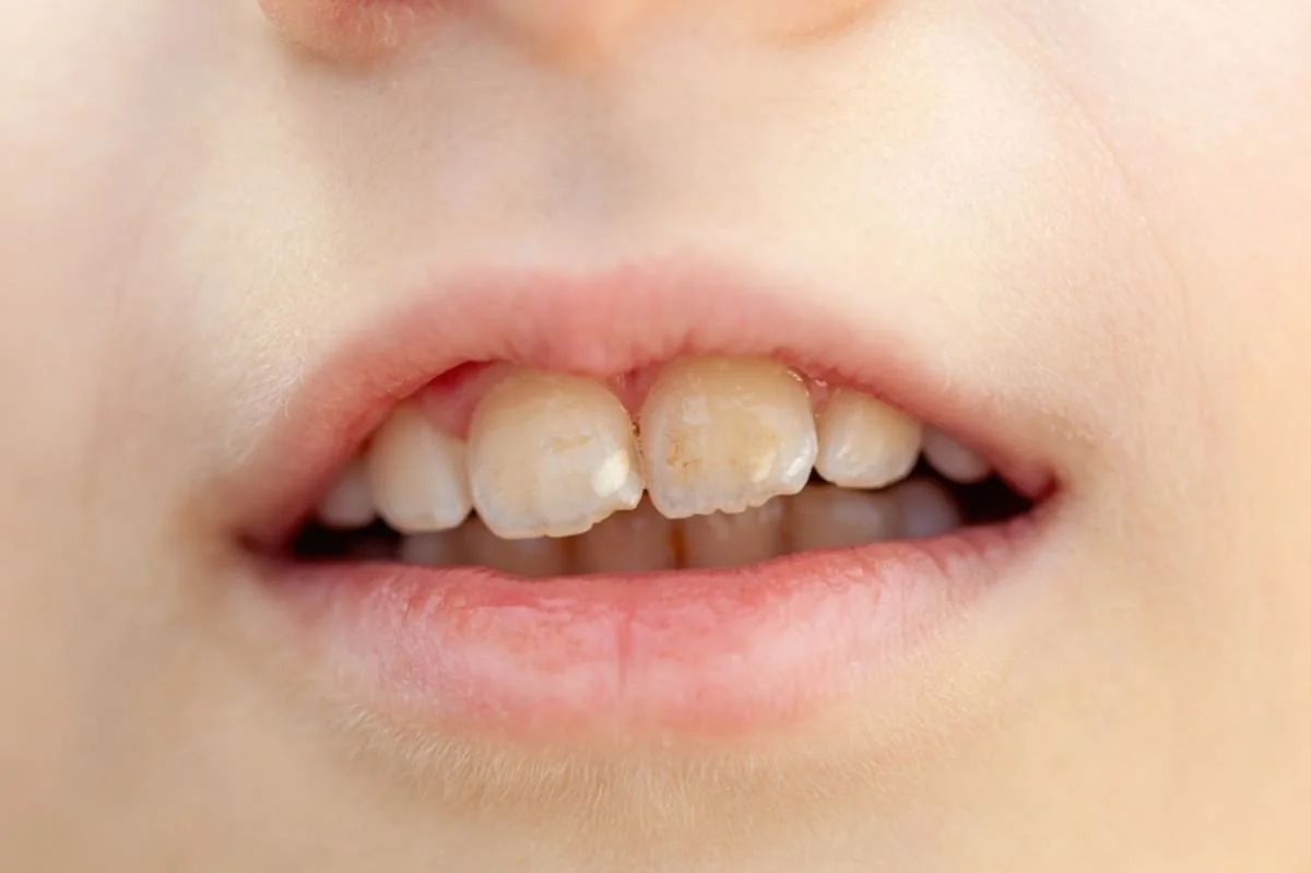 Fluoroza dentara la copii: simptome, tratament si preventie