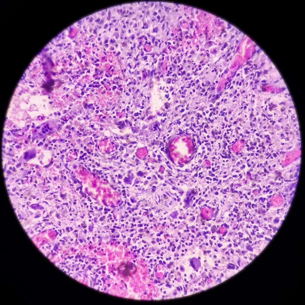 Diagnosticarea abcesului perianal Diagnosticarea abcesului perianal