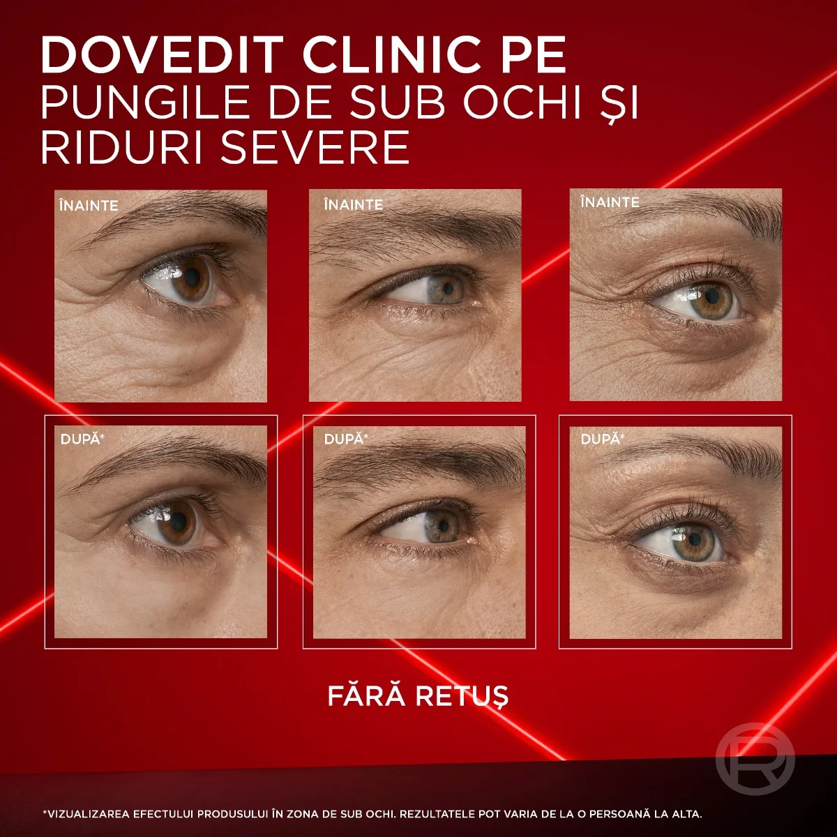 Crema corectoare pentru zona ochilor Revitalift Laser, 15ml, L'Oreal Paris