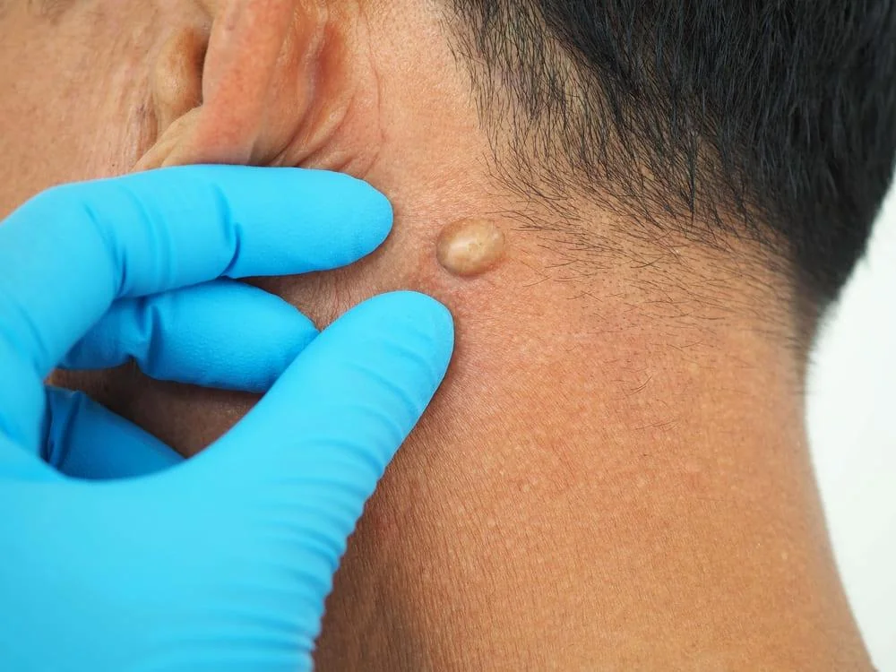 Chistul sebaceu: cauze, simptome, tratament