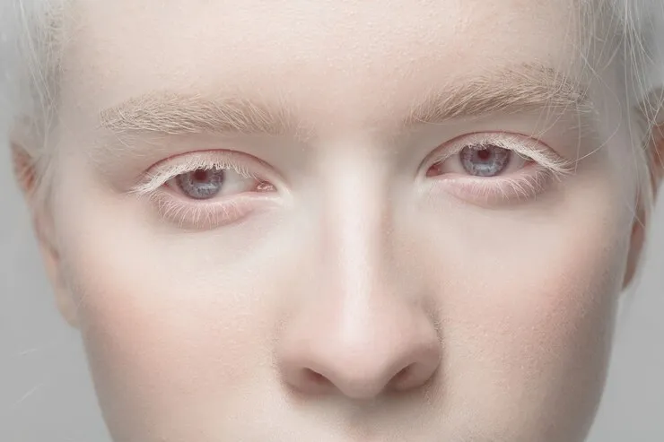 albinismul