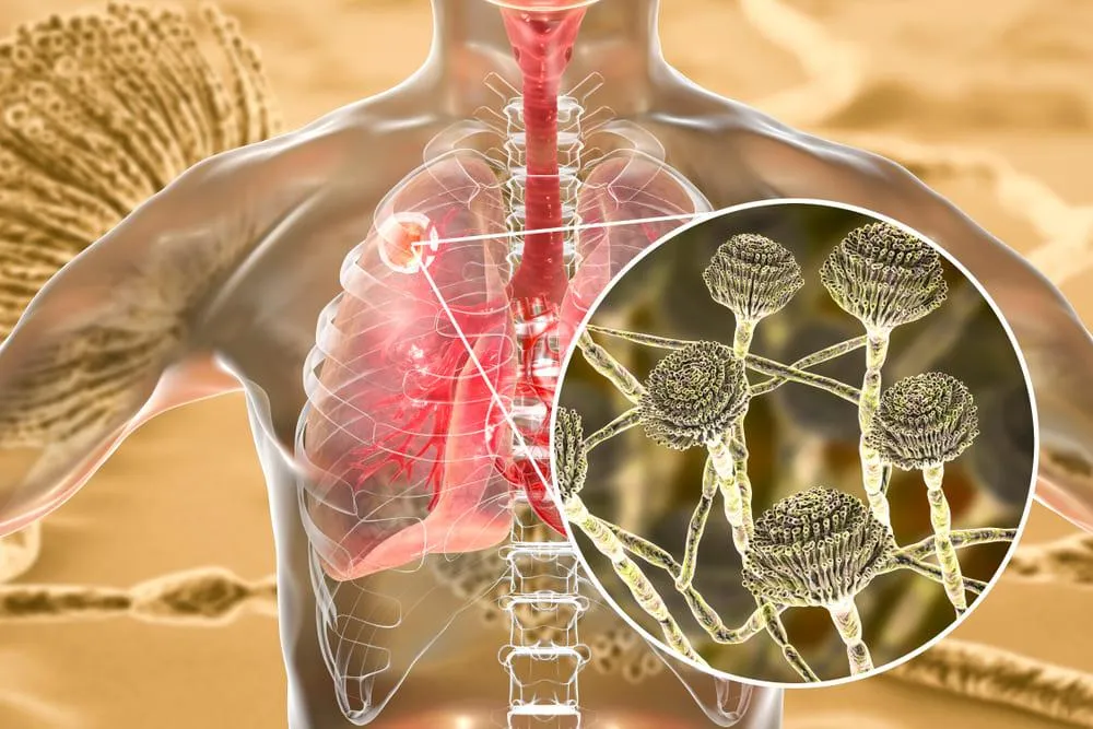 Aspergiloza: cauze, simptome, tratament