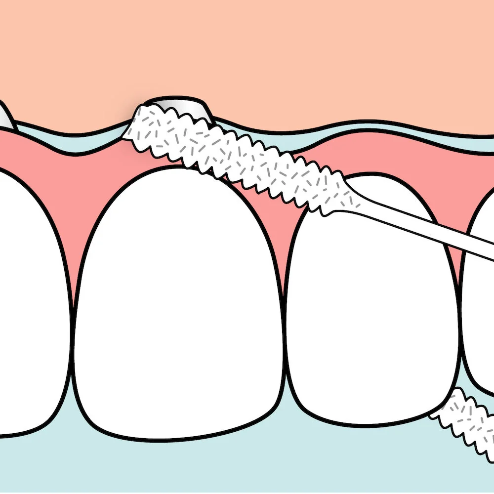 Ata detara pentru implanturi si lucrari Bridge&Implant Floss, 30 bucati, TePe