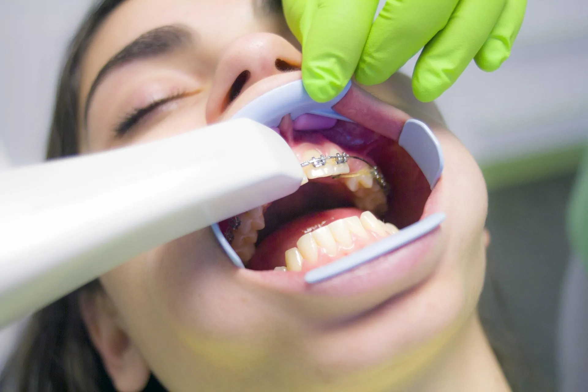 Ce presupune purtarea unui aparat dentar?
