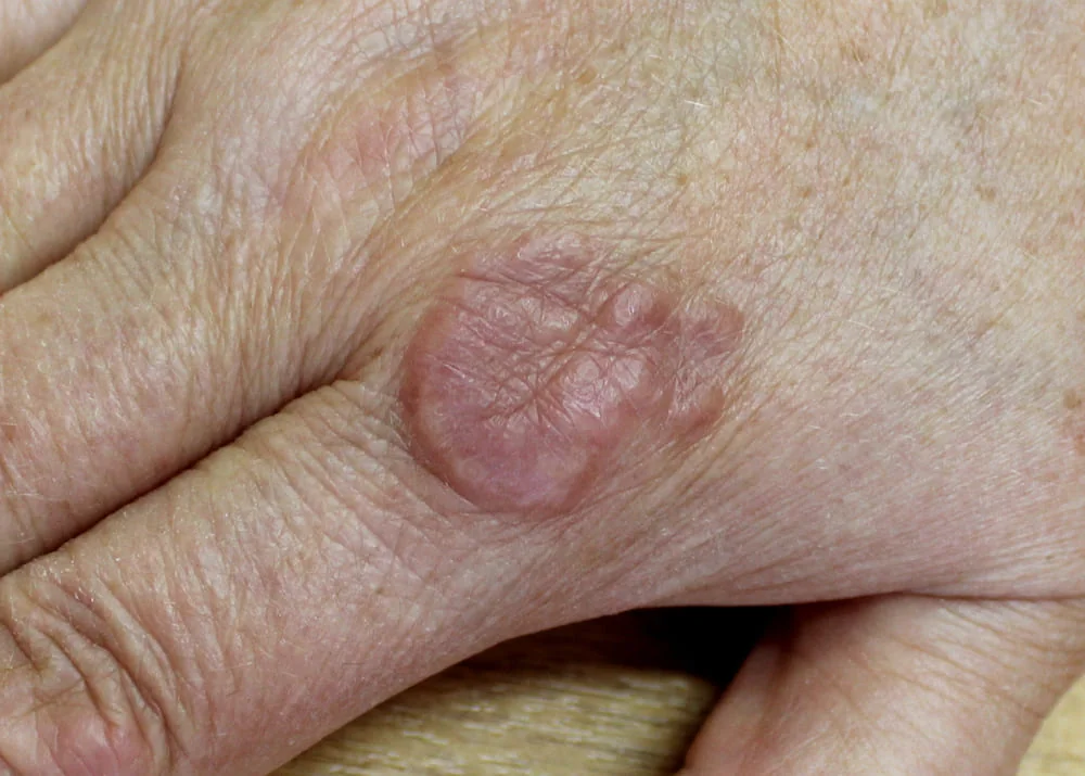 Granulom inelar (anular): cauze, simptome, tratament
