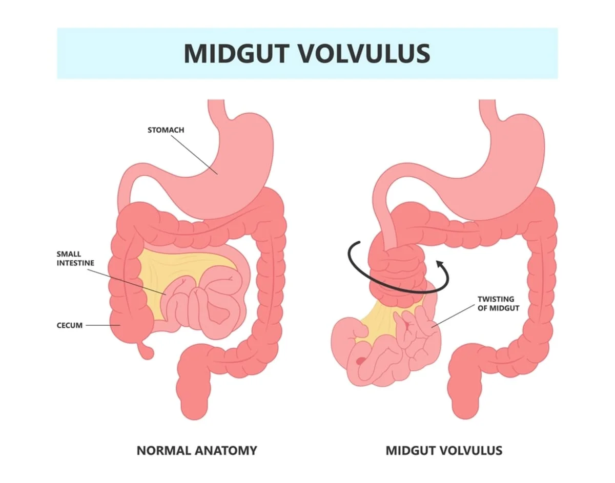 Volvulus intestinal: ce este, de ce apare si ce solutii ai