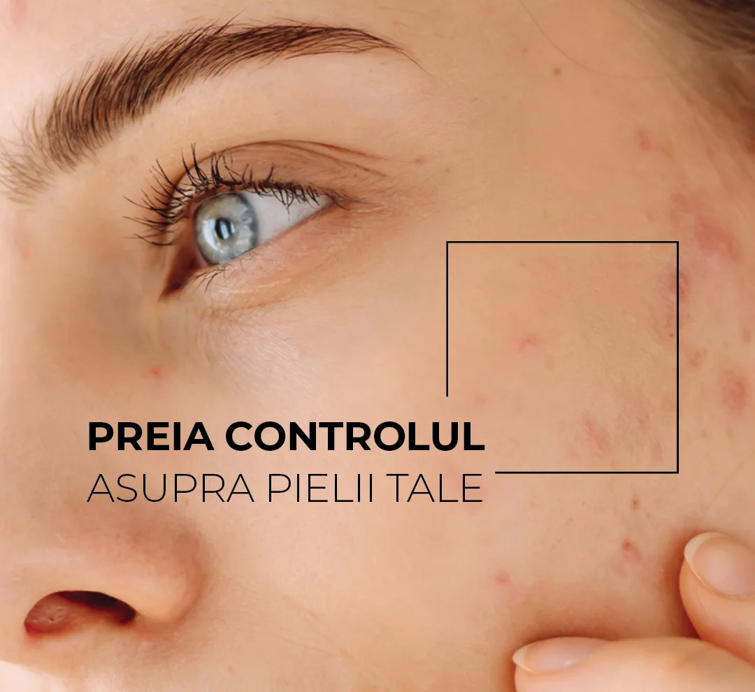 Skinexpert by Dr. Max® Acnepro | Dr. Max Farmacia