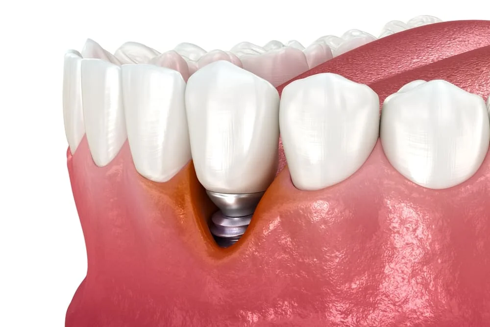 Periimplantita: cauze, simptome, tratament