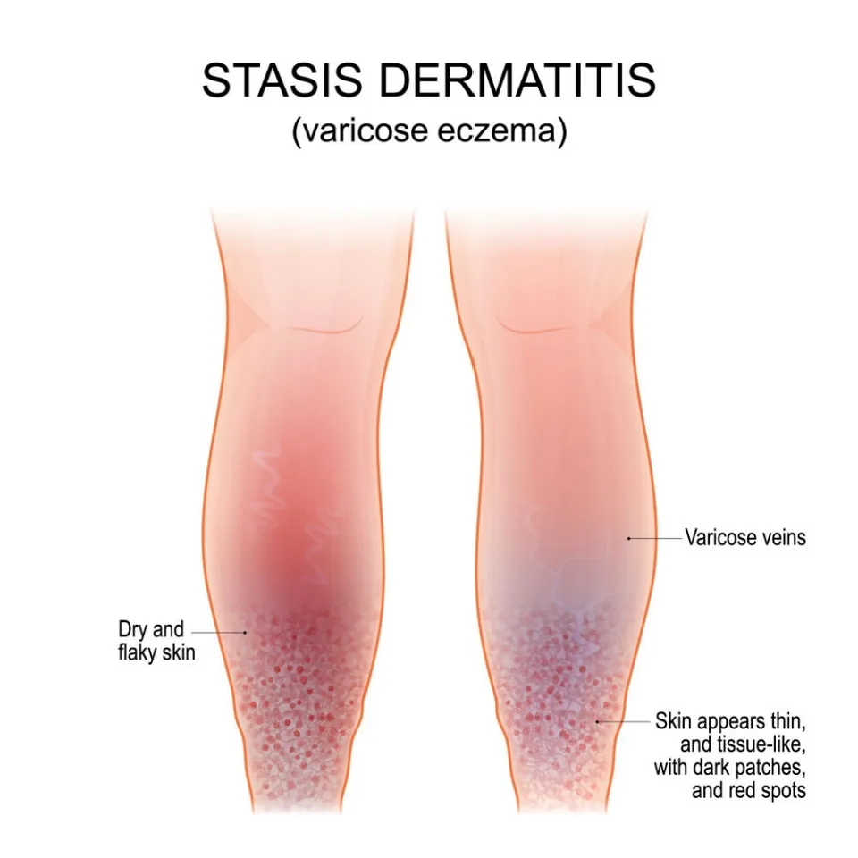 Dermatita de staza