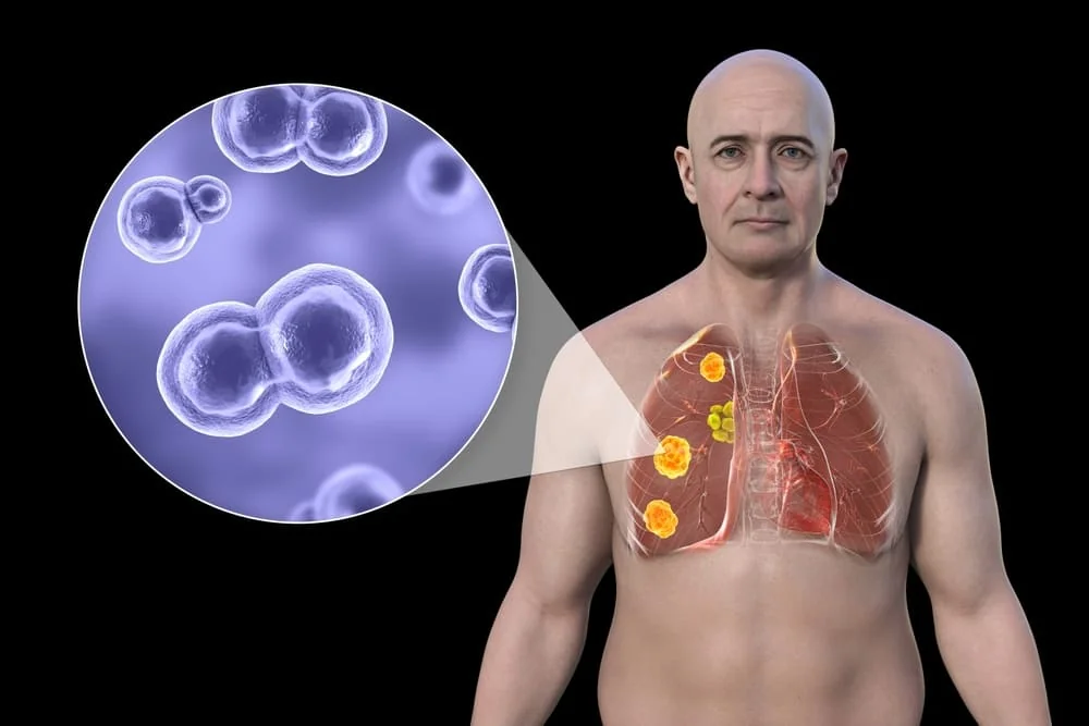Blastomicoza: cauze, simptome, tratament