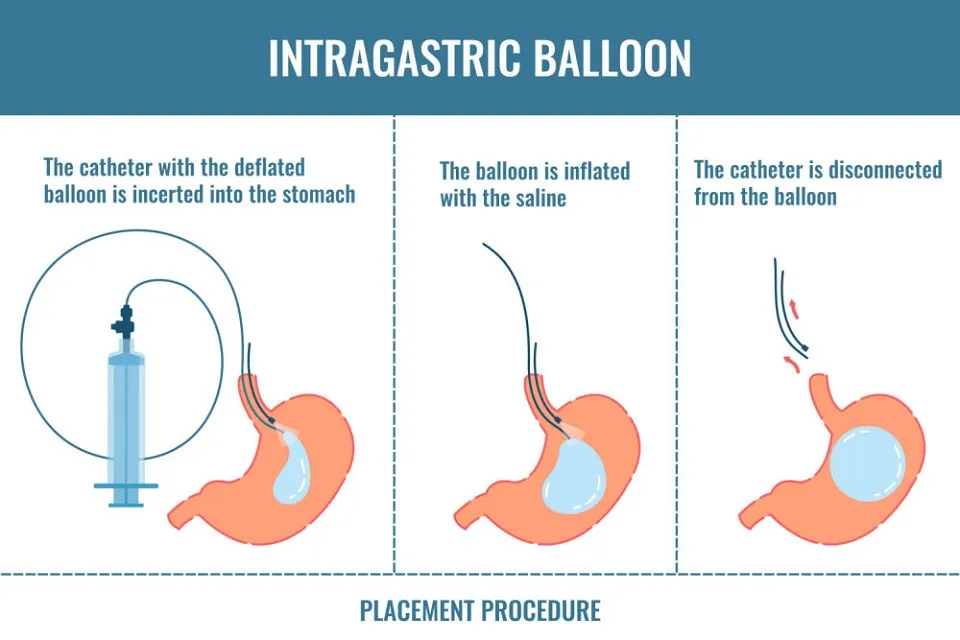 Intragastric baloon