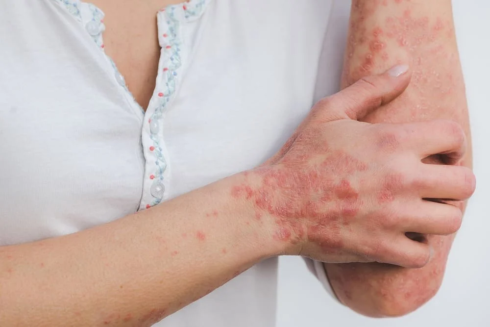 Factori declansatori ai psoriazisului la copii Factori declansatori ai psoriazisului la copii