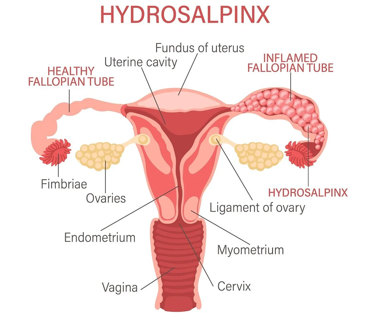 Hidrosalpinx: cauze, simptome, tratament