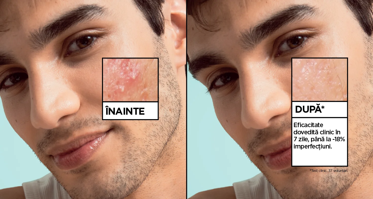 Comparatie inainte si dupa utilizarea serului Garnier pentru reducerea imperfectiunilor tenului. Comparatie inainte si dupa utilizarea serului Garnier pentru reducerea imperfectiunilor tenului.