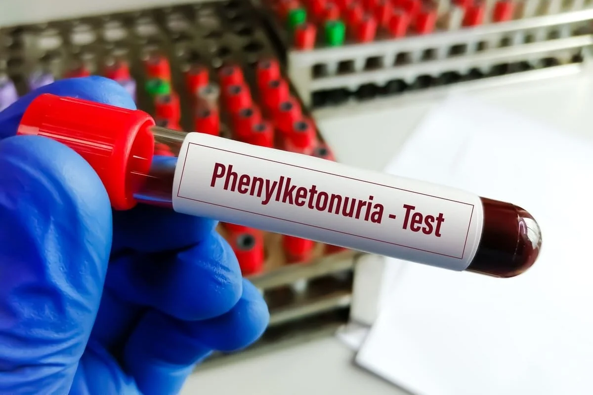Fenilcetonurie (PKU): cauze, simptome, tratament