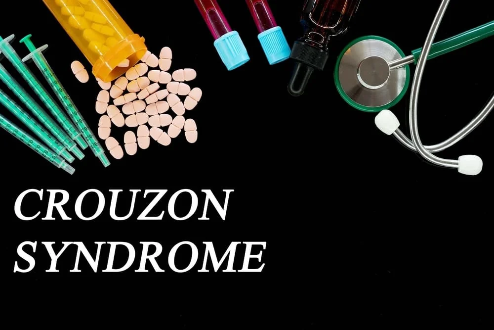 Sindrom Crouzon: cauze, simptome, tratament