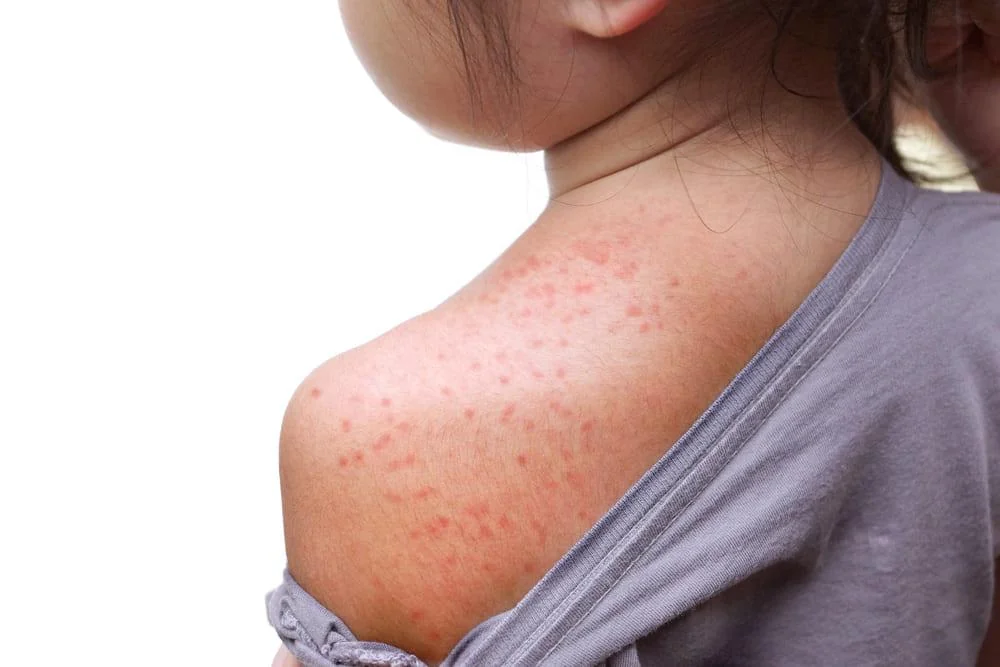 Roseola infantum: Cauze, simptome, tratament
