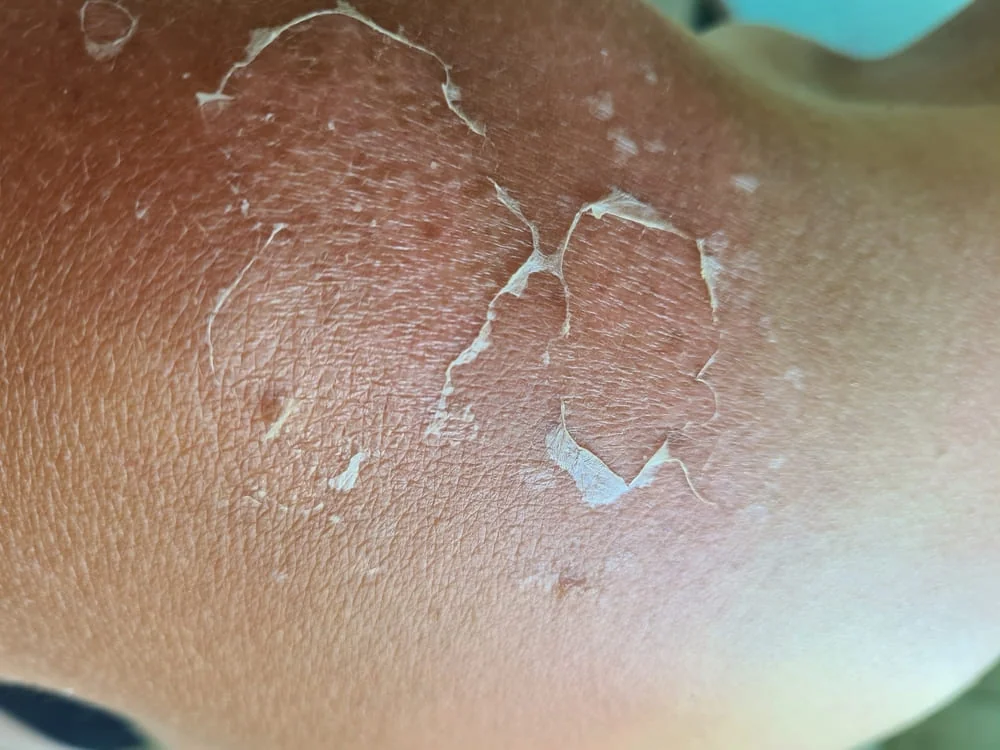 De ce se cojeste pielea dupa arsuri solare si ce trebuie sa faci?