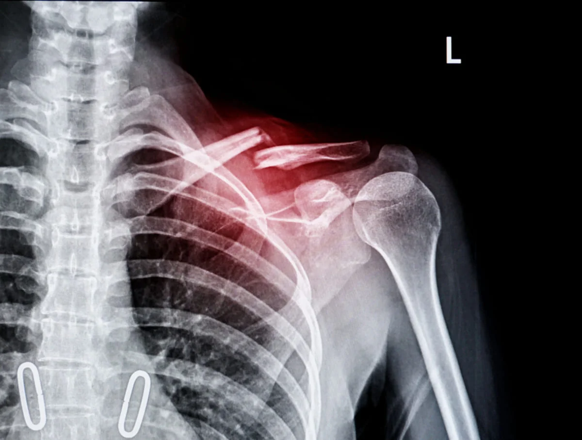 Fractura netratata: ce complicatii pot aparea pe termen lung?