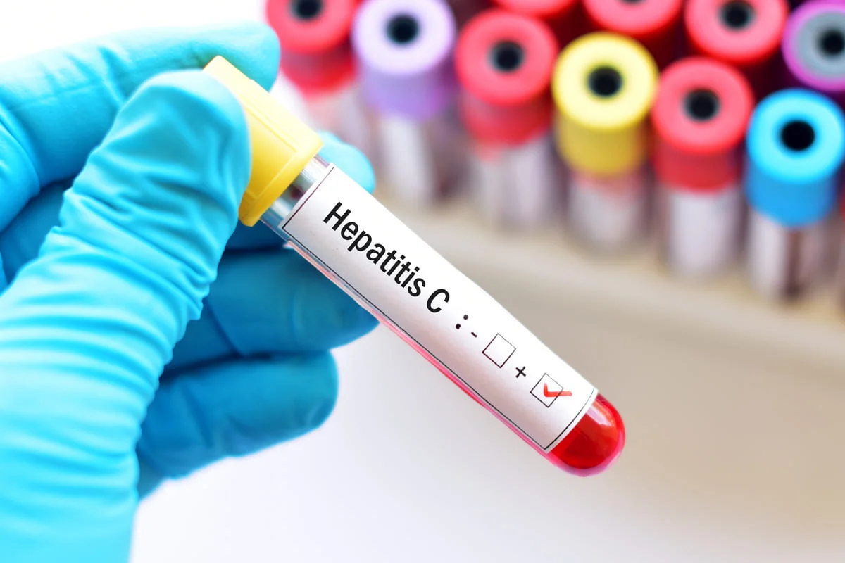 test de sange pentru diagnosticarea unui caz de hepatita c test de sange pentru diagnosticarea unui caz de hepatita c