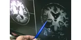 Lacunarismul cerebral: cauze, manifestari si optiuni de tratament