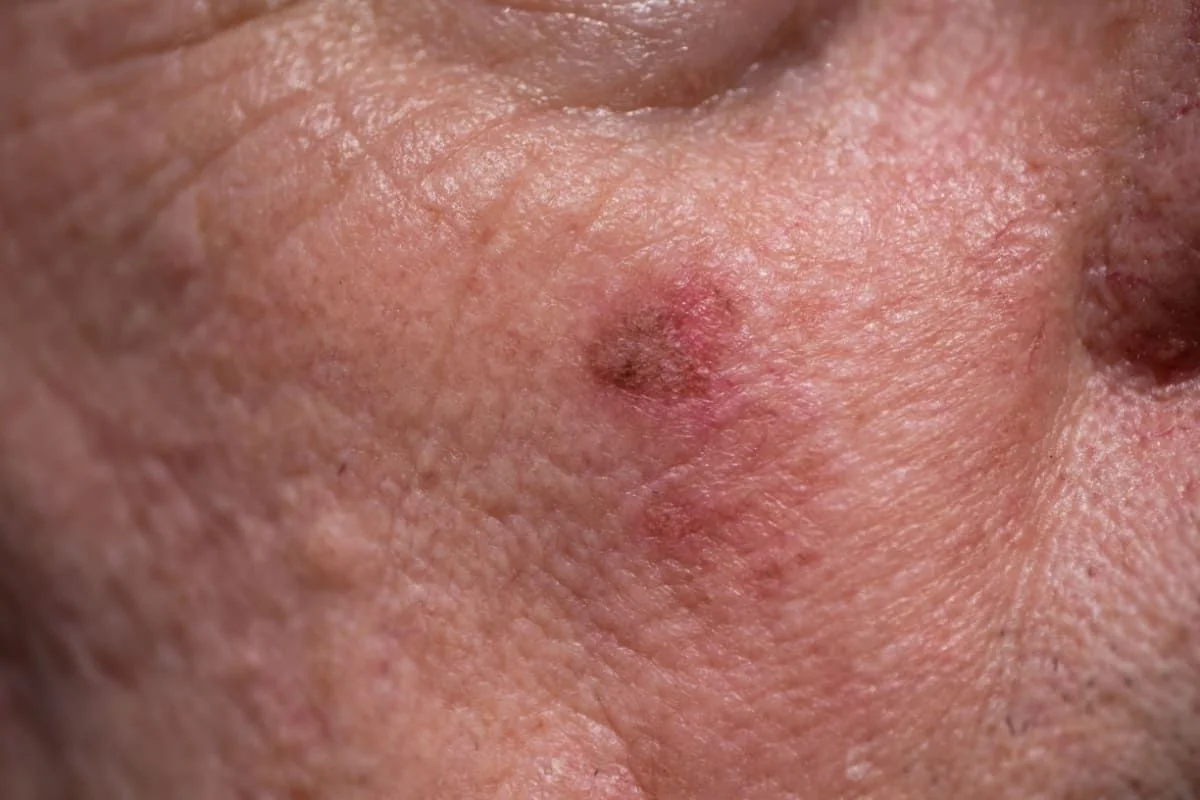 Carcinom scuamos: cauze, simptome, tratament