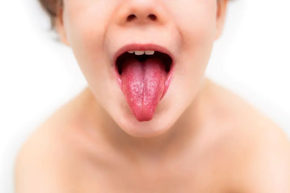 Scarlatina: ce este, cauze, simptome, tratament