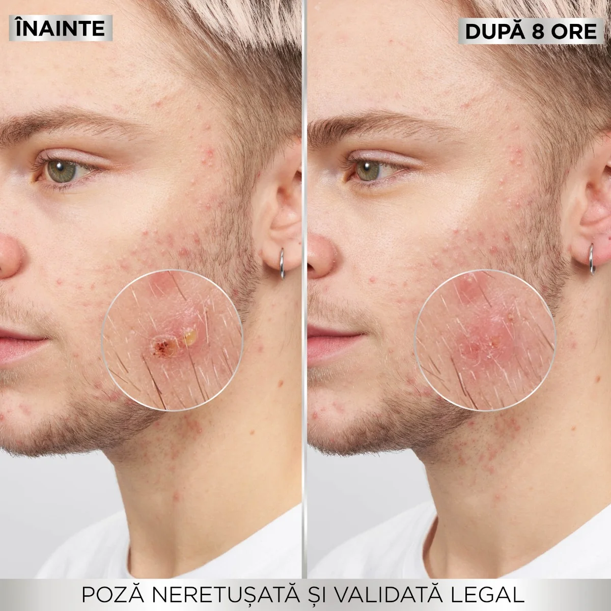 Plasturi hidrocoloidali Pure Active pentru cosuri, 8 bucati, Garnier