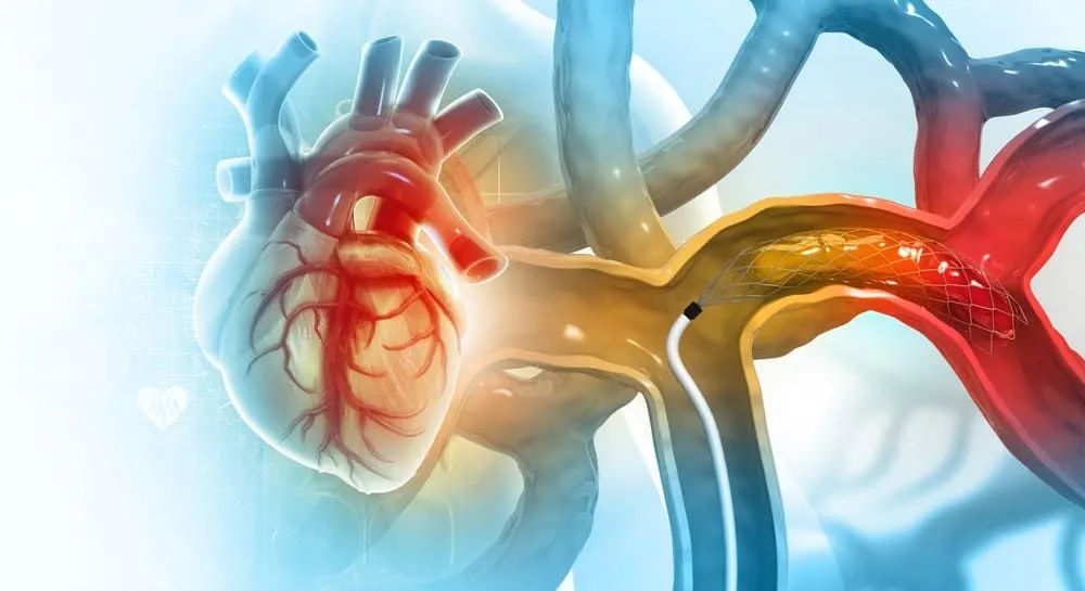 Angiografie coronariana (cateterism cardiac): ce trebuie sa stii