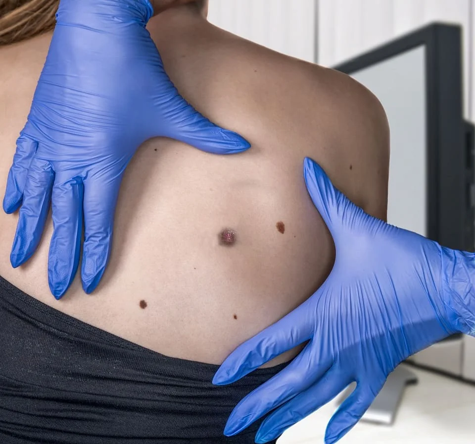 Cauzele hemangiomului Cauzele hemangiomului