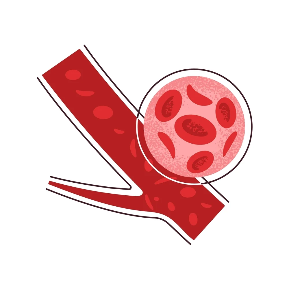 Siclemie (drepanocitoza, anemie falciforma): cauze, simptome, tratament