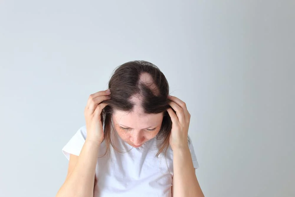 Alopecie (caderea parului): cauze, simptome, tratament