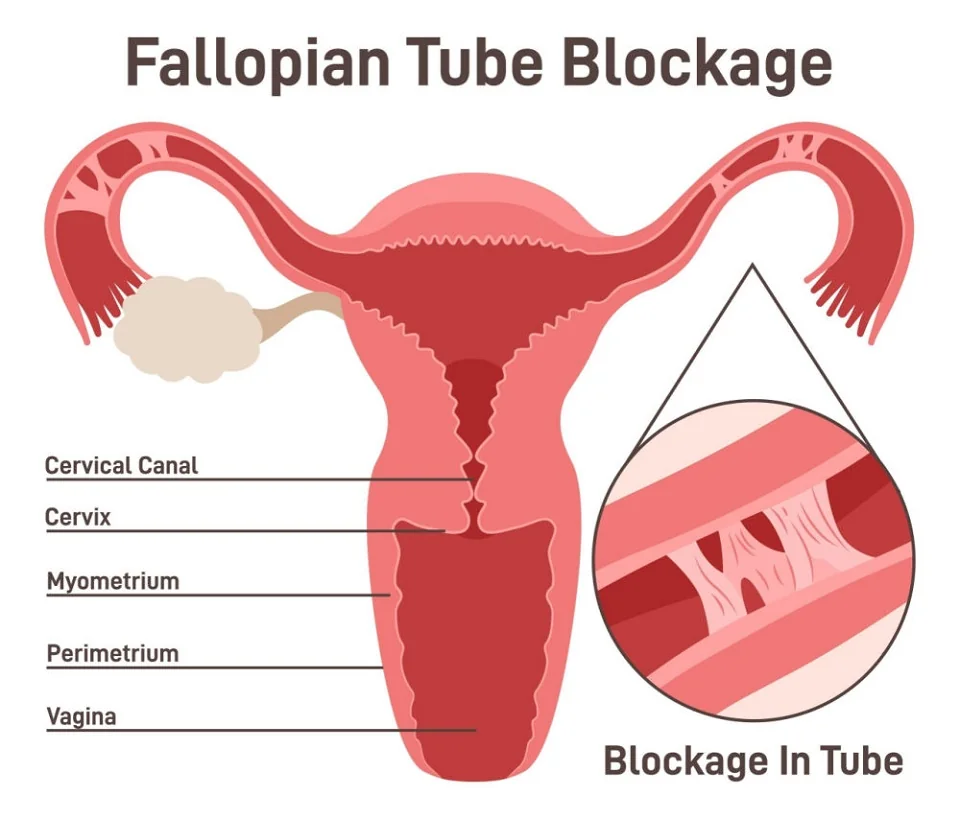 Blockage in tube Blockage in tube