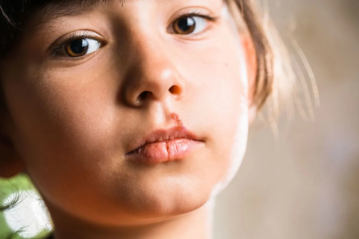 Herpes la copii: cauze, simptome, tratament