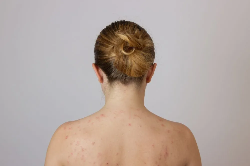 Cosuri pe spate (acneea corporala): cauze, simptome, tratament