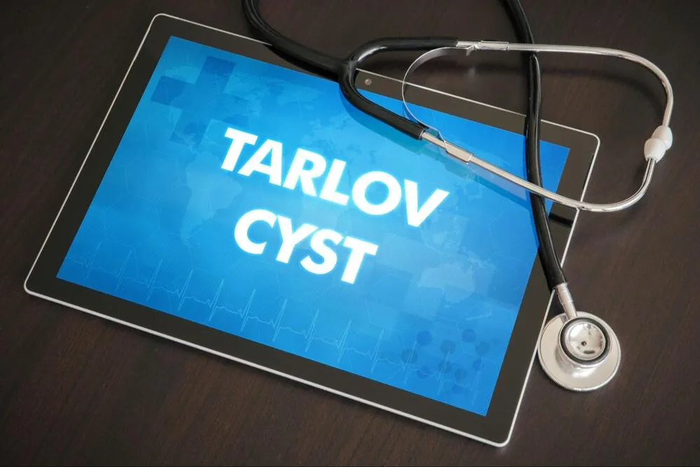 Diagnosticarea chisturilor Tarlov