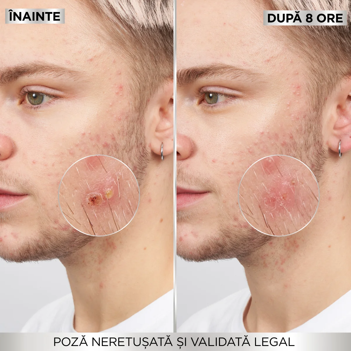 Plasturi invizibili pentru cosuri Pure Active, 22 bucati, Garnier