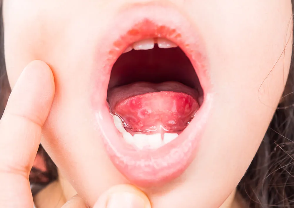 Glad Various corner Cele mai frecvente cauze ale bubelor pe sau sub limba | Dr.Max