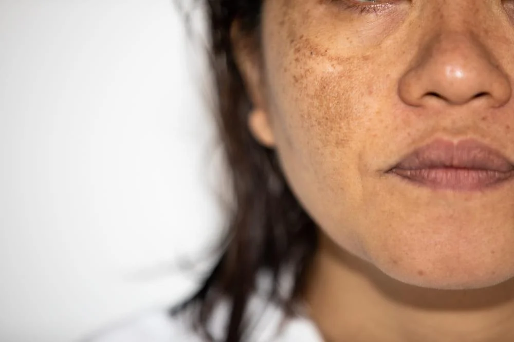 Melasma: cauze, simptome, tratament